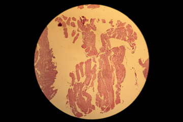 Pleural TB, plural biopsy muscle tissue 