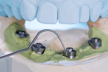Closeup/ Convertible abutment components/ Dental implant temporary abutment/ Abutment screw implant.