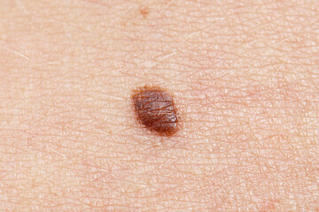 Basal Cell Carcinoma - pre-removal of a suspicious dark brown mole on the abdomen of a young woman.