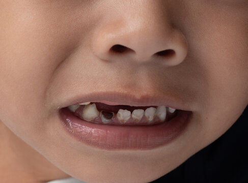 Kids try to smile with decay teeth