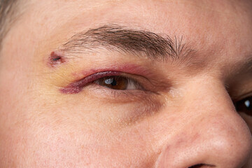 Obraz premium close view of a black eye, man's face with a hematoma