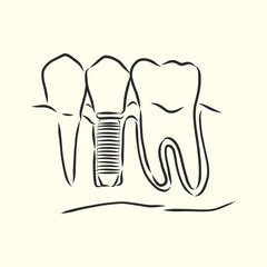 Vector illustration. sketches, dental implants. dental implant, vector sketch illustration
