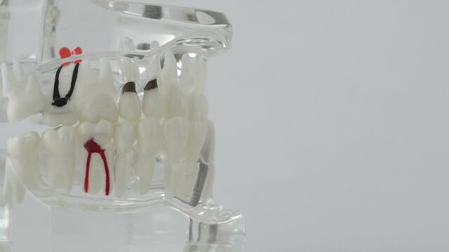 The layout of the human jaw on a white background with bad teeth. The concept of treatment of pulpitis and caries in dentistry, copy space