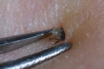 Super close up of sucking tick (Ixodes ricinus) removal with steel tweezers on human skin. Adult ticks feed on large mammals  for 6&ndash;13 days, before dropping off.         