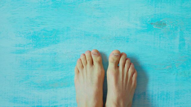 top view of man feet on blue backdrop. Feet with toenail damage toes. Medical treatment for bacterial foot fungus and nail bed trauma.