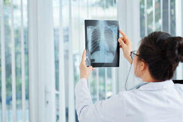 Doctor checking lungs x-ray of patient with lung inflammation indicating the presence of pneumonia