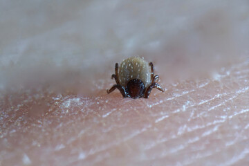 Super close up of sucking Ixodes ricinus on human skin. Adults feed on large mammals such as sheep, cattle, dogs, deer, humans, and horses for 6–13 days, before dropping off.