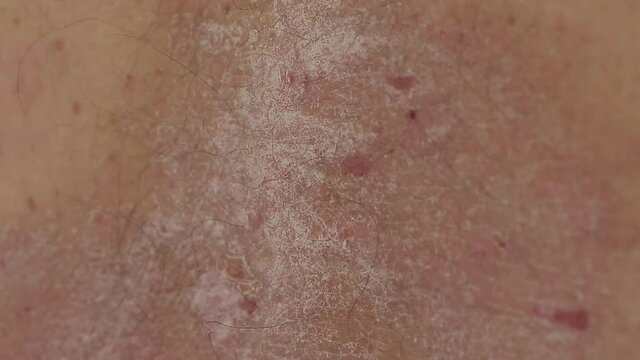 close up of a man running his hand over psoriatic rashes plaques and wounds