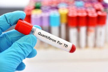 Naklejka premium Test tube with blood sample for Quantiferon test, diagnosis for mycobacterium tuberculosis infection