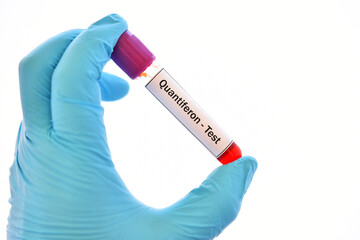 Fototapeta premium Test tube with blood sample for Quantiferon test, diagnosis for mycobacterium tuberculosis infection