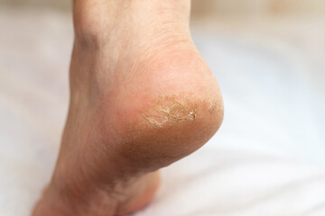Fototapeta premium Cracks on the heel. Skin care and treatment