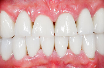 Porcelain, zirconia teeth in human mouth © Ocskay Bence