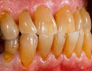 Porcelain, zirconia teeth in human mouth © Ocskay Bence