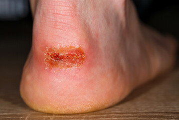 Fototapeta premium Painful injury on heel
