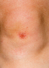 Fototapeta premium Wound on knee
