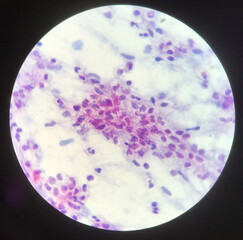Red branching mycobacterium tuberculosis on blue background in modified acid fast bacilli stain.