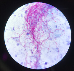 Red branching mycobacterium tuberculosis on blue background in modified acid fast bacilli stain.