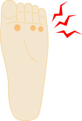 魚の目　痛い　足のイラスト © Kei A