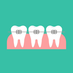 Teeth Braces - Vector Flat Illustration