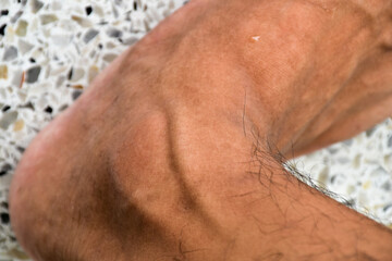 Close up blood vessel or vain appear skin foot area.
