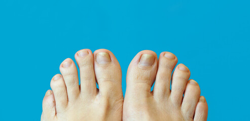 toes with nail psoriasis. female feet foot legs. A woman has ingrown toenails. short cutted nails....