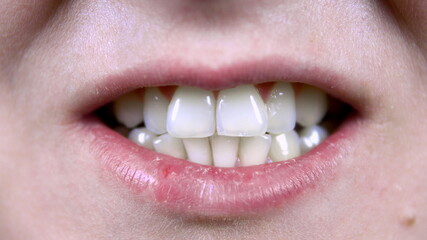 Young woman shows crooked teeth. Close-up