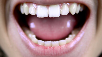 Young woman shows crooked teeth. The woman opened her mouth. Close-up.