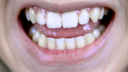 Young woman shows crooked teeth. The woman opened her mouth. Close-up.