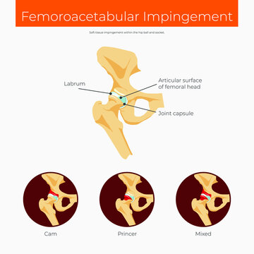 Femoroacetabular impingement cheme anatomy poster