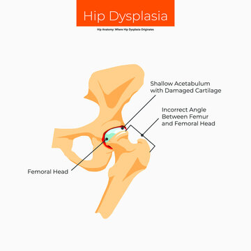 Hip Anatomy. Where Hip Dysplasia Originates