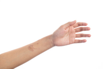 Oil burn platter on skin isolated in white background