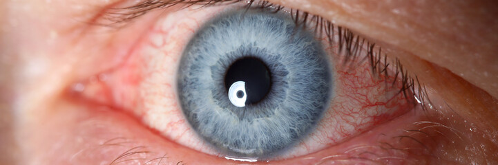 Irritated left blue male eye full with red capillar net
