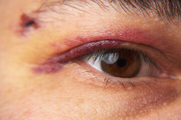 close view of a black eye, man's face with a hematoma