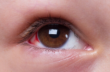 Close Up of two irritated red blood eyes.