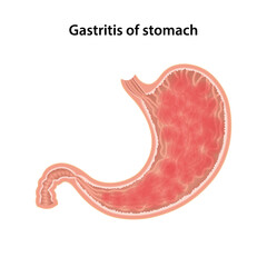 Gastritis of the stomach. Anatomical vector illustration of the gastritis of the stomach isolated over white background.