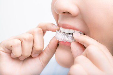 Woman wearing orthodontic silicone trainer. Mobile orthodontic appliance for dental correction....