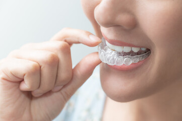 Woman wearing orthodontic silicone trainer. Mobile orthodontic appliance for dental correction....