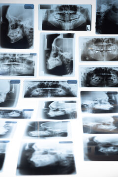 X-Ray scan of human teeth for analyzing and treating. Panoramic dental X-Ray for dentist on white background.