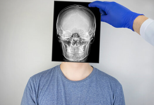 Survey radiography of the skull of a man. A doctor radiologist is studying an x-ray examination. A snapshot of the skull is placed on the patient’s head.