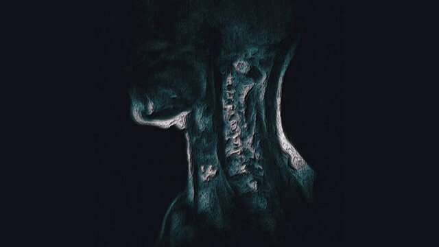 Voluminous color MRI of the cervical spine, detection of protrusions and hernias