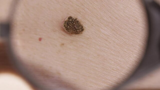 Melanoma on the woman's body
