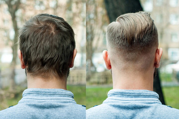 bald guy before after haircut Concept for a barber shop: the problem man of hair loss, alopecia,...