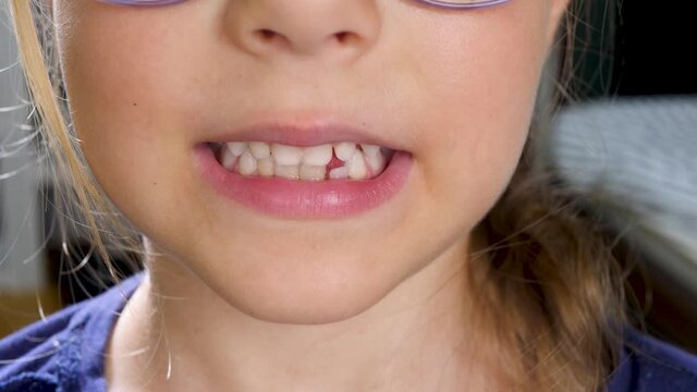 Little girl with wobbly tooth first milk temporary tooth. Dental medicine or temporary teeth healthcare concept. Tooth Fairy