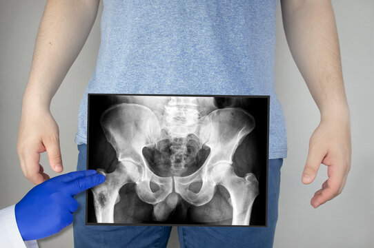 X-ray of the pelvic bones of a man. A doctor radiologist is studying an x-ray examination. A hip joint is placed on the patient’s body