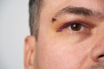 Obraz premium close view of a black eye, man's face with a hematoma