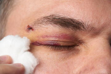 close view of a black eye, man's face with a hematoma