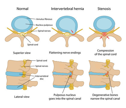 Intervertebral hernia and Spinal stenosis with description. Healthy disc and discs with intervertebral hernia and Spinal stenosis in superior and lateral views. Vector illustration
