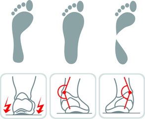 type of footprint icons type of pronation