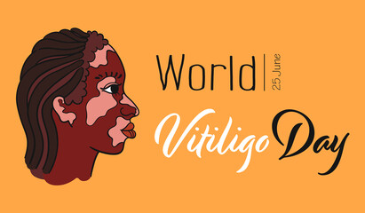 World Vitiligo Day. Dreadlocks hair girl with vitiligo pigment spots. Side view portrait of woman - Isolated vector. Female face with genetic skin problem