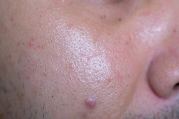 Fototapeta premium Young men's facial skin problems, Rough skin, Oily, Acne and Large pores.